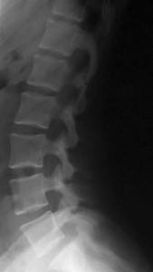 A normal lumbar spine radiograph in a patient who has terrible low back pain