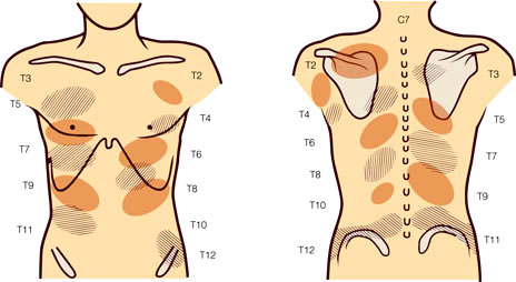 En generel præsentaton af, hvor og hvordan ribben smerter vil præsentere sig. Bemærk, at dette diagram præsenterer smertemønstre for rygsøjleleddene, men er nyttigt til illustration 