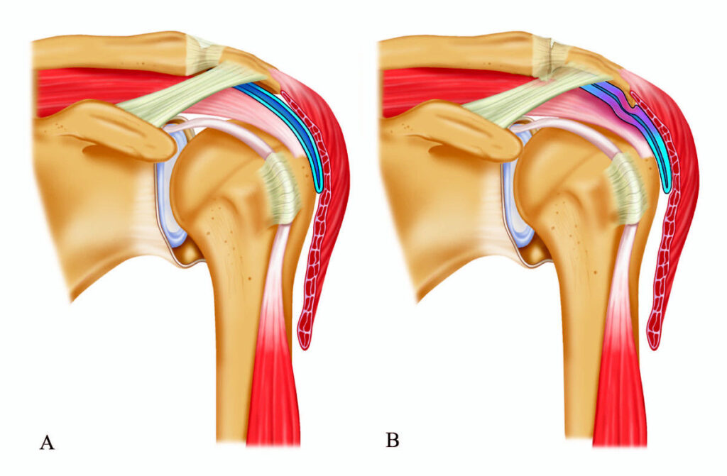 Shoulder pain relief Toronto | Best Shoulder Pain Treatment Toronto