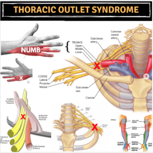 Thoracic outlet syndrome relief Toronto Dr Alex Ritza