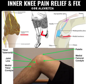 Knee pain relief Toronto | Patellofemoral joint pain relief in Toronto