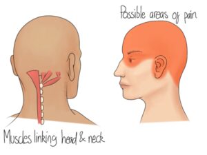 Cervicogenic and neck pain headache relief Dr Alex Ritza Toronto