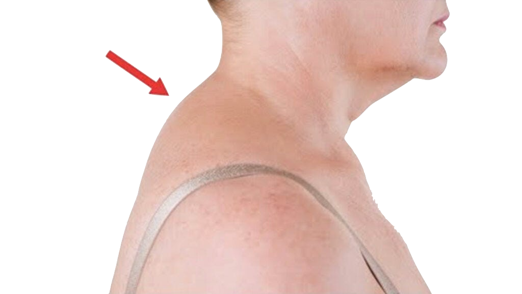 Neck hump treatment toronto | Trophic changes