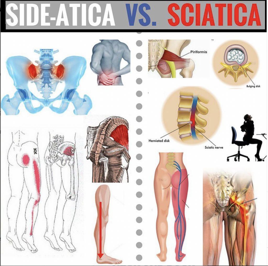 Outer Hip Pain and Outer Leg Pain Treatment Toronto | Sideatica Treatment Toronto