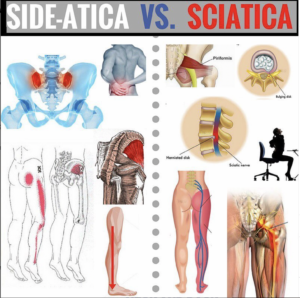Outer Hip Pain and Outer Leg Pain Treatment Toronto | Sideatica Treatment Toronto