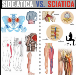 Outer Hip AND Thigh Pain Treatment Toronto | Sideactica Treatment Toronto