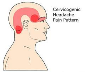 Back of head pain from the neck | cervicogenic headache treatment toronto