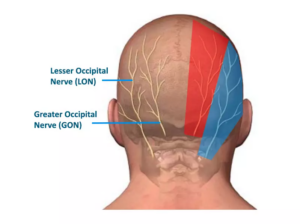 Occipital neuralgia | back of the head pain relief Toronto