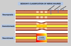 Arm & hand numbness Treatment Toronto | Why is my hand numb