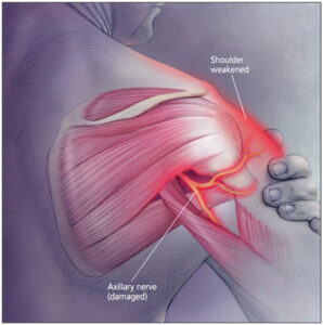 Peripheral nerve entrapment treatment Toronto