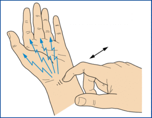 Do I Have Carpal Tunnel Syndrome Toronto