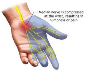 Best Carpal Tunnel Syndrome Treatment Toronto