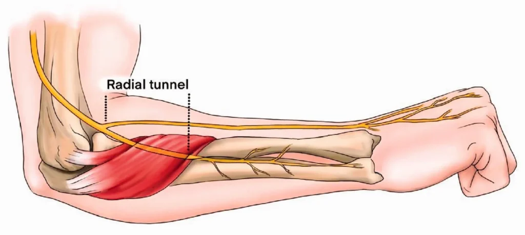 Best tennis elbow treatment in toronto